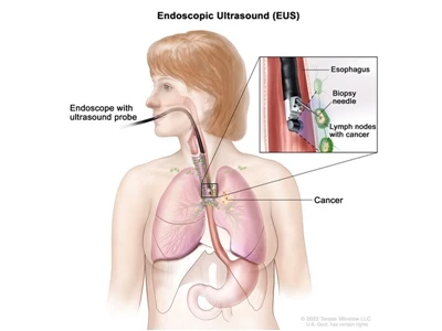 Ultrassom endoscópico (EUS)